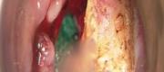 Laryngeal Surgery
Cordectomia Type V with CO₂ laser (2/3)

By courtesy of F. Algaba MD. ENT Department, Donostia Hospital - Spain