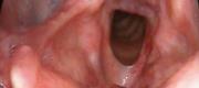 Laryngeal Surgery
Cordectomia Type V with CO₂ laser (3/3)

By courtesy of F. Algaba MD. ENT Department, Donostia Hospital - Spain