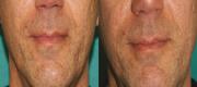 Acne Scars

Nd:YAP Laser (1340nm)
Courtesy of:  G. Primavera, MD and D. Raskovic, MD - Rome, Italy