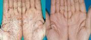 Palmar Psoriasis
Courtesy of: G. Leone MD - IFO - (Rome - Italy) - A. Alomar et al. - Hospital de la Santa Creu i Sant Pau (Barcelona - Spain)