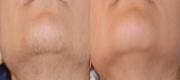 Hair Removal
Hirsutism treated with Nd:YAG
Courtesy of A. Le Pillouer - Prost, MD - Marseille, France