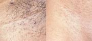 Hair Removal
Courtesy of: Régia Celli Ribeiro Patriota MD-Luiz Carlos Cucé MD