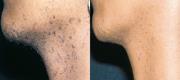 Hair Removal
Courtesy of: Régia Celli Ribeiro Patriota MD-Luiz Carlos Cucé MD