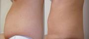 Laserlipolysis
Laser-Assisted Liposuction
Courtesy of: G. Addamo, Gynaecologist  and A. Gaspar, Gynaecologist - Argentina