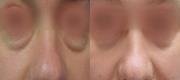 Eye Bags Laserlipolysis 
Courtesy of N. Zerbinati, Dermatologist - Italy