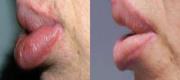 Lips Laserlipolysis
Treatment of Silicoma (adverse reaction to dermal filler)
Courtesy of N. Zerbinati, Dermatologist - Italy