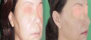 Skin Tightening