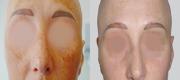 Lesioni Pigmentate Benigne
Melasma trattato con laser CO₂