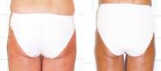 Cellulite
Courtesy of:  P. Gilardino, MD and A. Pelosi, physiotherapist
Milan, Italy