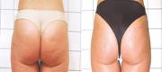 Cellulite
Courtesy of:  P. Gilardino, MD and A. Pelosi, physiotherapist
Milan, Italy