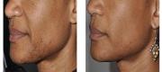 Nd:YAG Laser – Moveo Technology

(A) patient condition before any treatment; (B) two months after only one treatment.

[Courtesy of P. Bonan, M.D. and M. Troiano, M.D. – Florence, Italy]