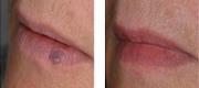 Nd:YAG Laser

Lower lip senile haemangioma. 
[Courtesy of F. Patarin, M.D. – Challans, France]