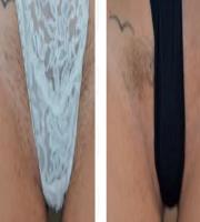 Hair removal 
Alexandrite laser with Moveo technology
Courtesy of P. Bonan, M.D. and M. Troiano, M.D. - Florence, Italy