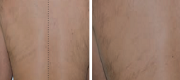 Hair removal
Courtesy of P. Bonan, M.D. and M. Troiano, M.D. - Florence, Italy