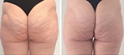 Treatment of Cellulite with Onda