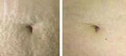 Stretch marks treated with SmartXide Punto