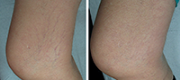 Treated with Motus AY Nd:YAG laser source