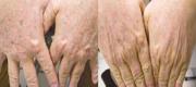 Benign Pigmented Lesions
Hand Photorejuvenation with Intense Pulsed Light

Courtesy of : G. Cannarozzo, MD - P. Bonan, MD - P. Campolmi, MD. 
Florence, Italy