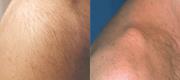 Hair Removal
Courtesy of: J. L. Levy MD - Marseille, France