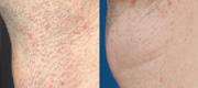 Hair Removal
Courtesy of: J. L. Levy MD - Marseille, France