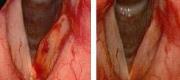 CO₂ Laryngeal Surgery: Oedema

By courtesy of S. Dallari MD. ENT Department, Fermo Hospital - Italy