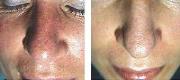 Vascular Lesions
Diffuse Rosacea Treated with Dye Laser

Courtesy of  J.L. Levy, MD. Marseille – France