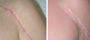 Hypertrophic and Telangiectatic Scar Treated with Dye Laser

Courtesy of  A. Le Pillouer-Prost, MD. Marseille – France