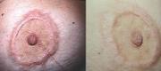 Red and Hypertrophic Scar Treated with Dye Laser

Courtesy of  J.L. Levy, MD. Marseille – France