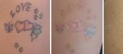 Tattoo Removal
Multi-coloured amateur tattoo treated with both 532nm & 1064nm wavelengths (QS Laser)

Courtesy of N. Zerbinati, MD. Pavia – Italy