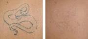 Tattoo Removal
Black amateur tattoo treated with 1064nm wavelength (QS Laser)

Courtesy of B. Corradino, MD. Palermo – Italy