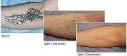 Tattoo Removal
Black tattoo treated with 1064nm wavelength (QS Laser)

Courtesy of B. Corradino, MD. Palermo – Italy