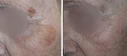 Benign Pigmented Lesions
Treatment with 532nm wavelength (QS Laser)


Courtesy of Prof R. Galimberti, MD – G. Galimberti, MD – D. Galimberti, MD. Buenos Aires – Argentina