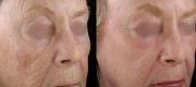 Fractional Skin Resurfacing – CO₂ DOT Therapy

Courtesy of  D.S. Sarnoff, MD. New York City – NY, USA