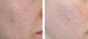 Acne Scars – CO₂ DOT/RF Therapy

Courtesy of S. Tenna, MD -  A. Cogliandro, MD – L. Piombino, MD. Rome – Italy