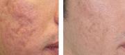 Acne Scars – CO₂ DOT/RF Therapy

Courtesy of S. Tenna, MD - A. Cogliandro, MD – L. Piombino, MD. Rome – Italy