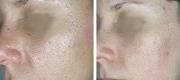 Acne Scars – CO₂ DOT/RF Therapy

Courtesy of Prof. P. Bonan, MD - Prof. P. Campolmi, MD - Prof. G. Cannarozzo, MD. Florence – Italy