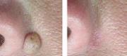 Skin Surgery
Miescher Nevus Treated with CO₂ Laser

Courtesy of Prof. P. Bonan, MD - Prof. P. Campolmi, MD - Prof. G. Cannarozzo, MD. Florence – Italy