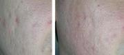 Acne Scars – CO₂ DOT Therapy

Courtesy of Prof. P. Bonan, MD - Prof. P. Campolmi, MD - Prof. G. Cannarozzo, MD. Florence – Italy