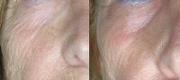 Fractional Micro-Ablative Photorejuvenation – CO₂ DOT Therapy
Lower Eyelids Treatment

Courtesy of Prof. P. Bonan, MD - Prof. P. Campolmi, MD - Prof. G. Cannarozzo, MD. Florence – Italy