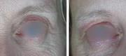 Fractional Micro-Ablative Photorejuvenation – CO₂ DOT Therapy
Upper Eyelids Treatment

Courtesy of Prof. P. Bonan, MD - Prof. P. Campolmi, MD - Prof. G. Cannarozzo, MD. Florence – Italy