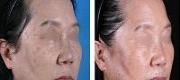 Superficial Benign Pigmented Lesions – CO₂ DOT Therapy

Courtesy of Bea Gee Young, MD. Seoul – Korea