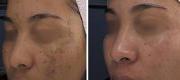 Benign Pigmented Lesions – CO₂ DOT Therapy
Melasma

Courtesy of  G. Gutiérrez Lopes, MD. Laserstetic Clinic, Costa Rica