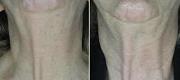 Fractional Skin Resurfacing – CO₂ DOT Therapy
Neck Rejuvenation

Courtesy of Prof. P. Bonan, MD - Prof. P. Campolmi, MD - Prof. G. Cannarozzo, MD. Florence – Italy