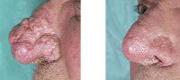 Skin Surgery
Rhinophyma Treated with CO₂ Laser

Courtesy of Prof. P. Bonan, MD - Prof. P. Campolmi, MD - Prof. G. Cannarozzo, MD. Florence – Italy