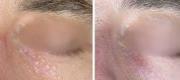 Skin Surgery
Syringoma Treated with CO₂ Laser

Courtesy of Prof. P. Bonan, MD - Prof. P. Campolmi, MD - Prof. G. Cannarozzo, MD. Florence – Italy