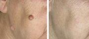 Skin Surgery
Dermal Nevus Treated with CO₂ Laser

Courtesy of Prof. P. Bonan, MD - Prof. P. Campolmi, MD - Prof. G. Cannarozzo, MD. Florence – Italy