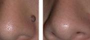 Skin Surgery
Dermal Nevus Treated with CO₂ Laser

Courtesy of Prof R. Galimberti, MD – G. Galimberti, MD – D. Galimberti, MD. Buenos Aires, Argentina