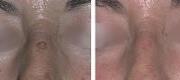 Skin Surgery
Hyperchromias Treated with CO₂ Laser

Courtesy of Prof R. Galimberti, MD – G. Galimberti, MD – D. Galimberti, MD. Buenos Aires, Argentina