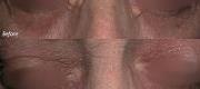 Skin Surgery
Xanthelasma Treated with CO₂ Laser

Courtesy of Prof R. Galimberti, MD – G. Galimberti, MD – D. Galimberti, MD. Buenos Aires, Argentina