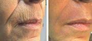 Skin Resurfacing with Er:YAG Laser
Perilabial Wrinkles

Courtesy of Prof. P. Bonan, MD - Prof. P. Campolmi, MD - Prof. G. Cannarozzo, MD. Florence – Italy